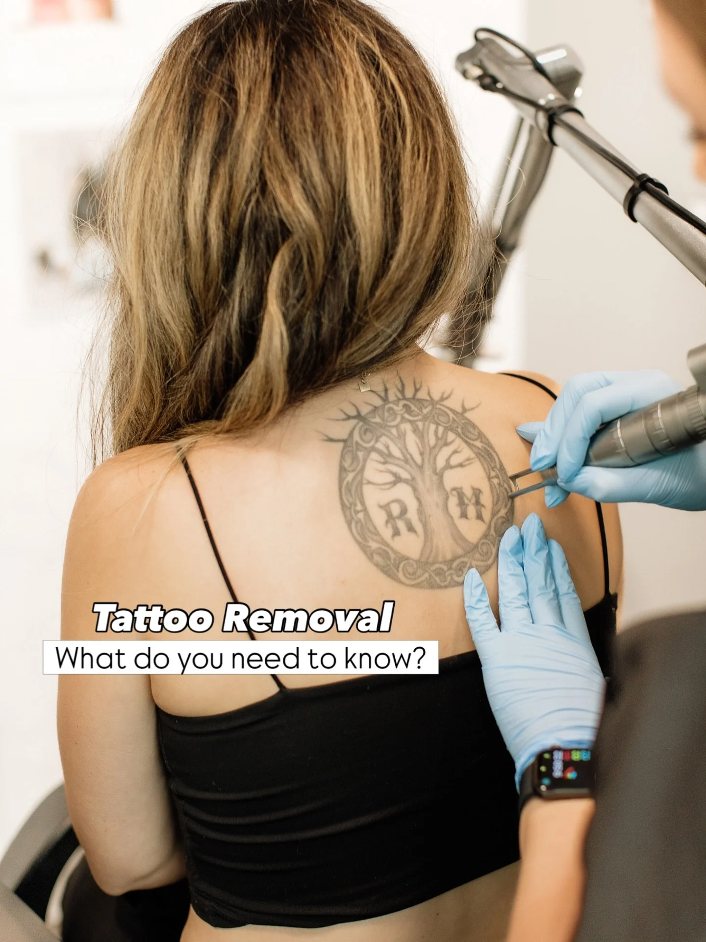 Laser tattoo removal uses concentrated light beams to break down tattoo ink into tiny particles. Your body&rsquo;s immune system then gradually removes these particles over time.

🎨 Ink Colors Matter:Darker colors like black absorb more laser energy