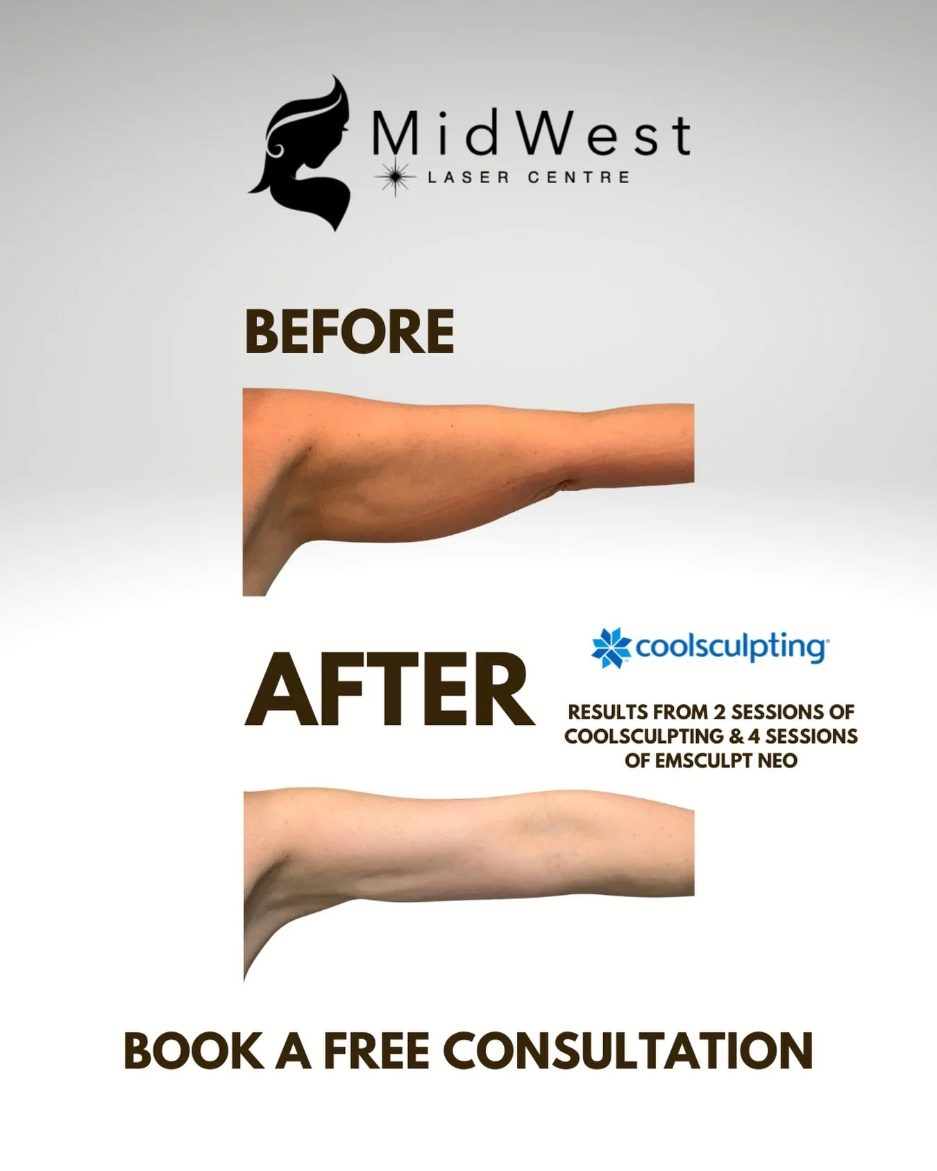 Yes. THIS. Sleeveless season is coming&hellip; we think! 🤔 
Results from CoolSculpting take approx 8-16 weeks to see. This is the exact reason it&rsquo;s time to book your treatment now. Meet with one of our experienced laser technicians for a free 