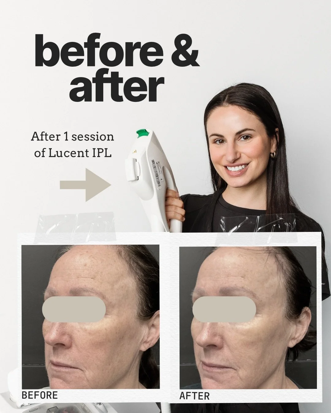 >>> SWIPE >>> for results. 
IPL is a fave around here! It&rsquo;s the perfect solution for uneven skin tone caused by sun damage or aging. We recommend multiple sessions for optimal results, all with zero to very minimal downtime. L