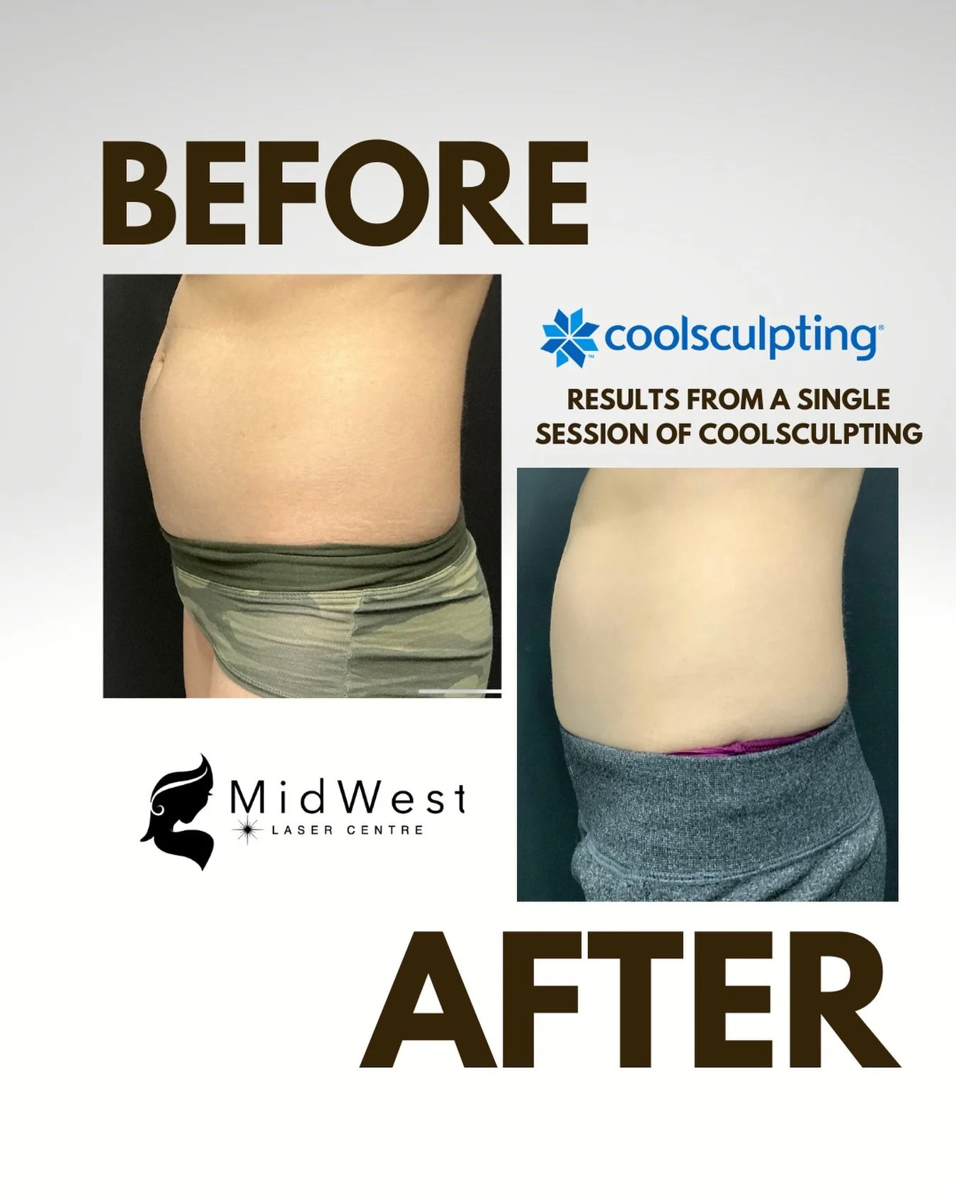 ✨ Transform your body with CoolSculpting! Check out this incredible before and after result from just one session! 

How CoolSculpting Works: This non-invasive procedure uses controlled cooling to eliminate stubborn fat cells in targeted areas, like 