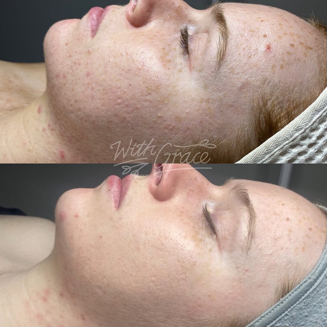 This beautiful client has been committed to having regular Enzyme Therapy treatments and following her home care plan whilst working alongside a naturopath to treat internal factors. The proof is in the pictures. This sh*t works 😏
.
.
.
#withgracesm