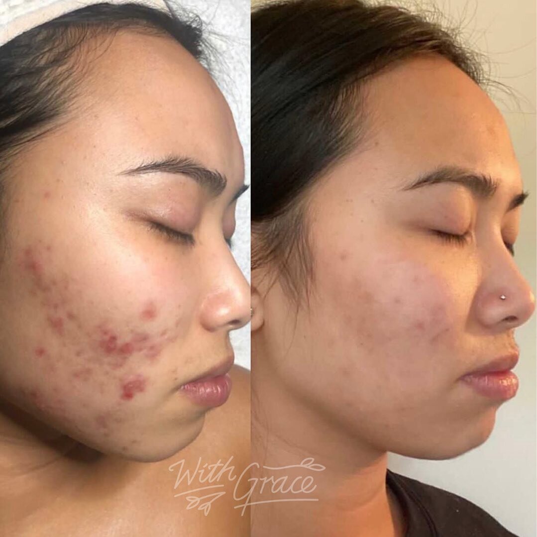 Thou shalt not pick 🫡

Book an advanced skin analysis with one of our acne experts and start your journey to clear skin today 😀
.
.
.
#withgracesm #acneexpert #acnefacial #acnefacialmelbourne #dermavidualsmelbourne #dermaviduals #dermavidualsfacial