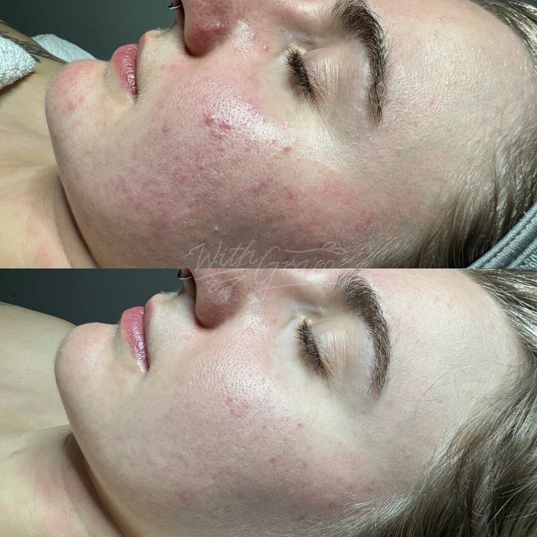 Can you believe these photos are only TEN days apart?! 🤯

Less inflammation ✔️
Less congestion ✔️
Ecstatic Client ✔️
.
.
.
#withgracesm #dermaviduals #dmk #dmkskin #betagel #acnetreatment #acne #inflamedskin #congestedskin #skinexpert #melbourneskin