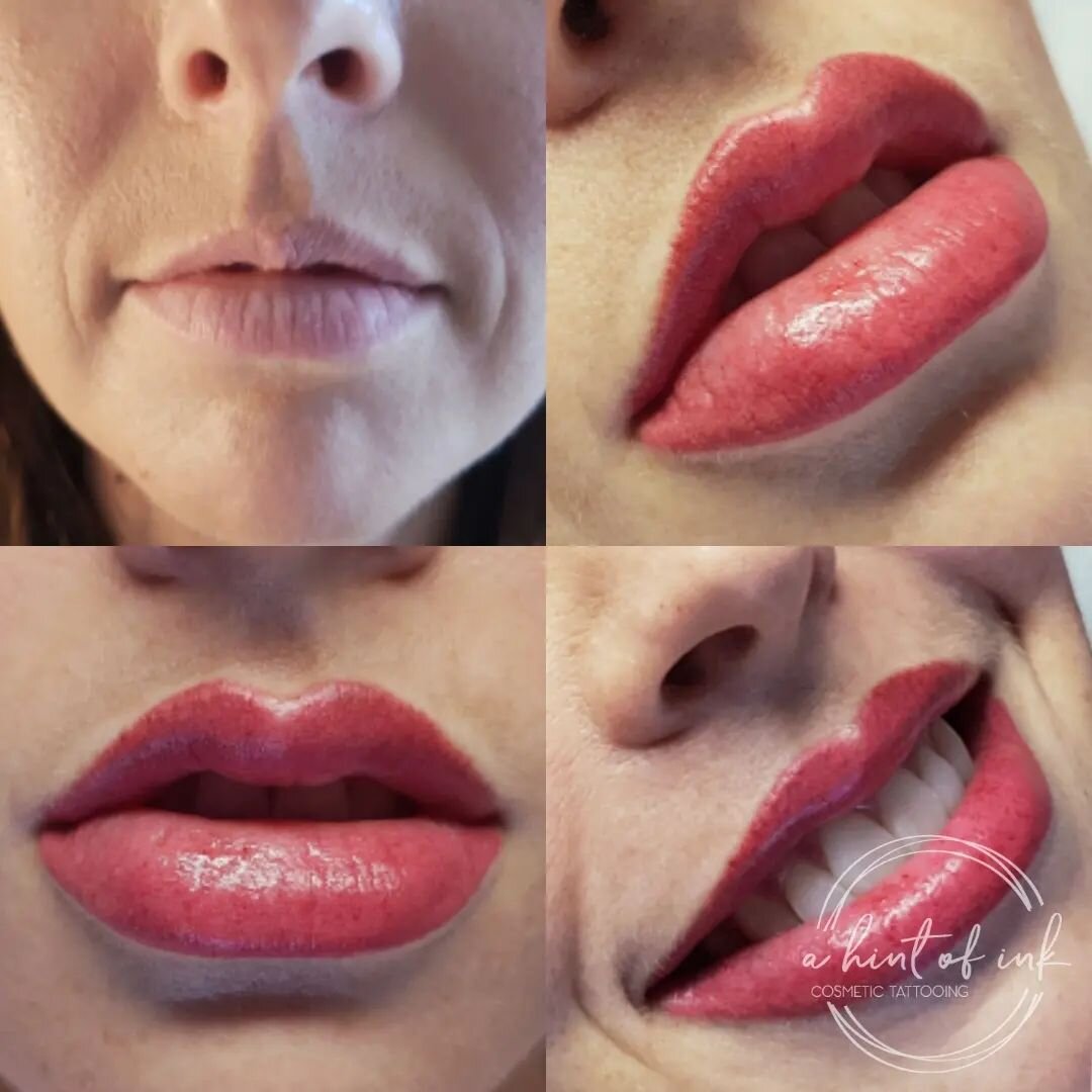 A lip blush tattoo improves the natural colour and shape of the lips. By implanting a gentle, sheer layer of pigment, we achieve a subtle hue resembling a natural lip tint, or we can opt for a richer pigment for a lipstick-like appearance. This techn