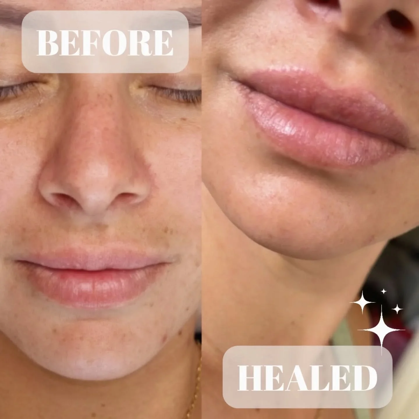 What is a Lip Blush Tattoo?

A Lip Blush Tattoo isn&rsquo;t meant to replace your favourite bold lipstick. It&rsquo;s designed to enhance your natural lip tone, define the shape, and give a subtle flush of colour that looks effortless. Think of it as