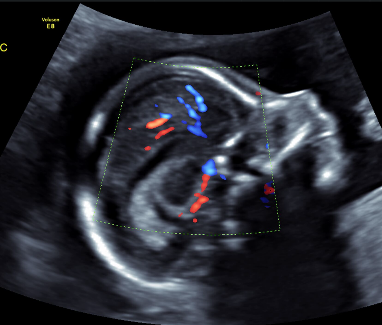 Early ultrasound testing