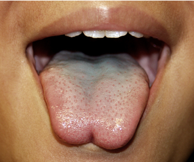 Tongue-tie