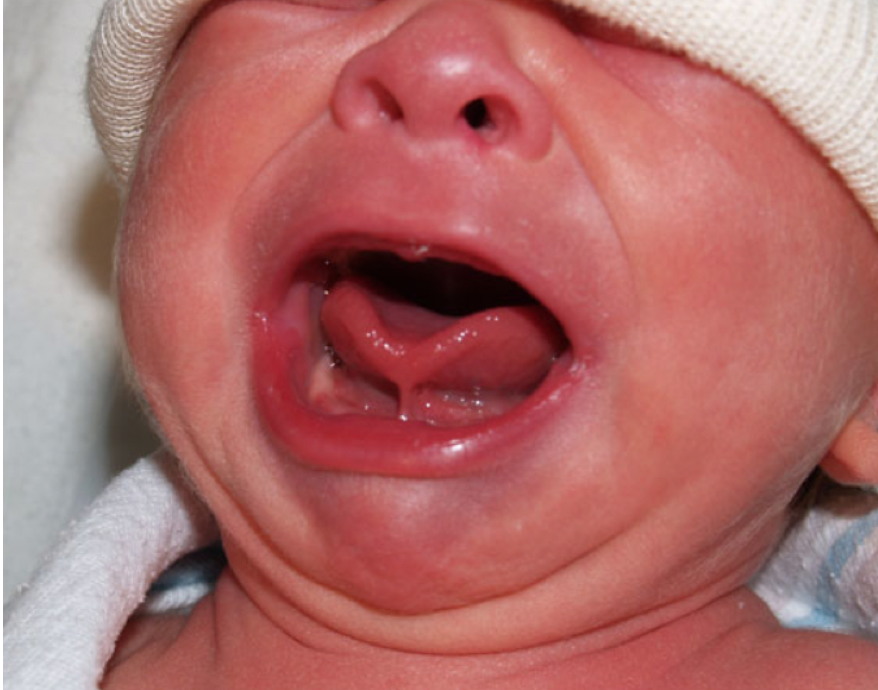 Tongue-tie for clinicians