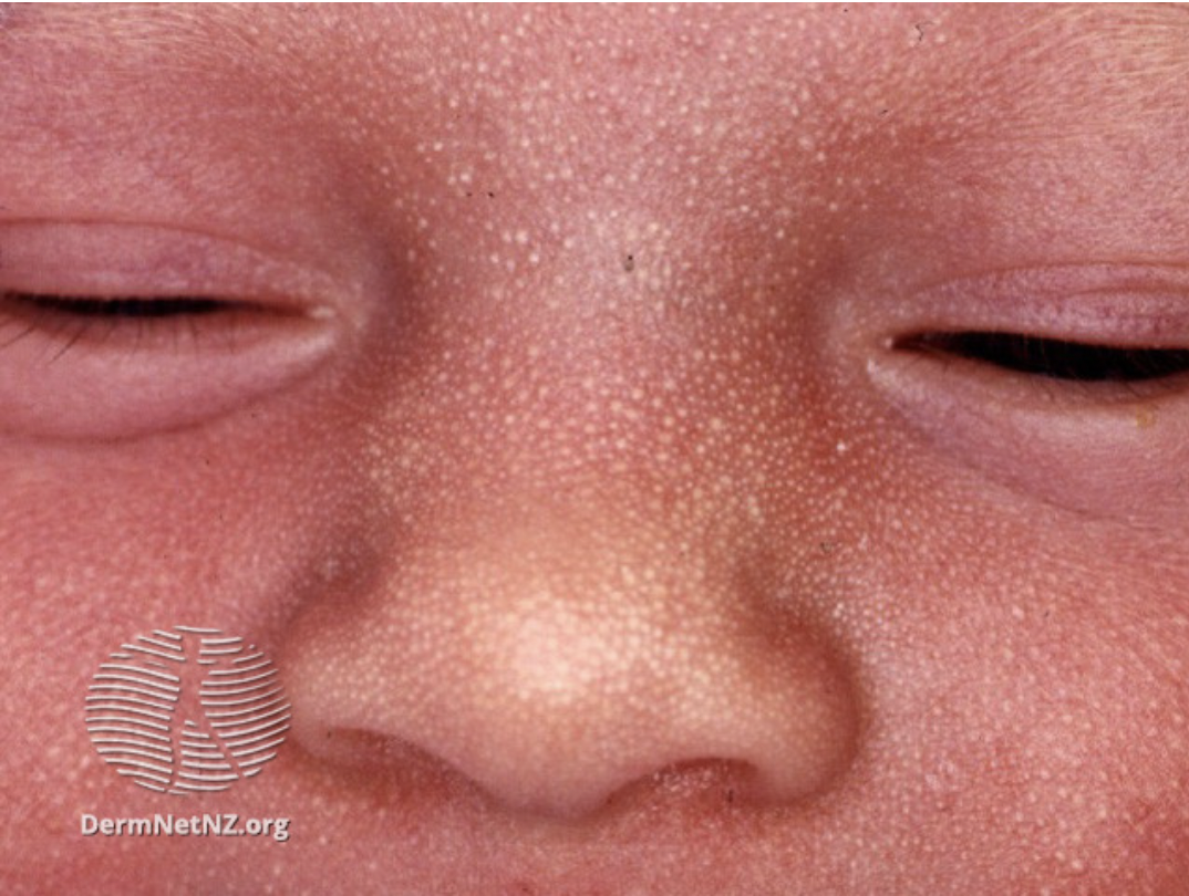 Rashes In Newborns Making Sense Of The Dots And Spots — Maternity Matters