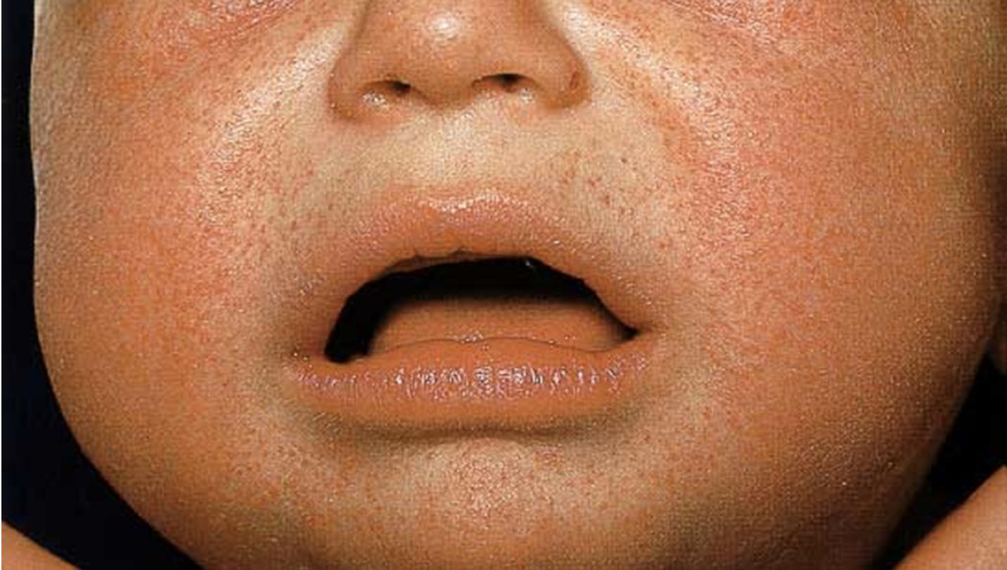 Rashes in newborns making sense of the dots and spots — MaternityMatters