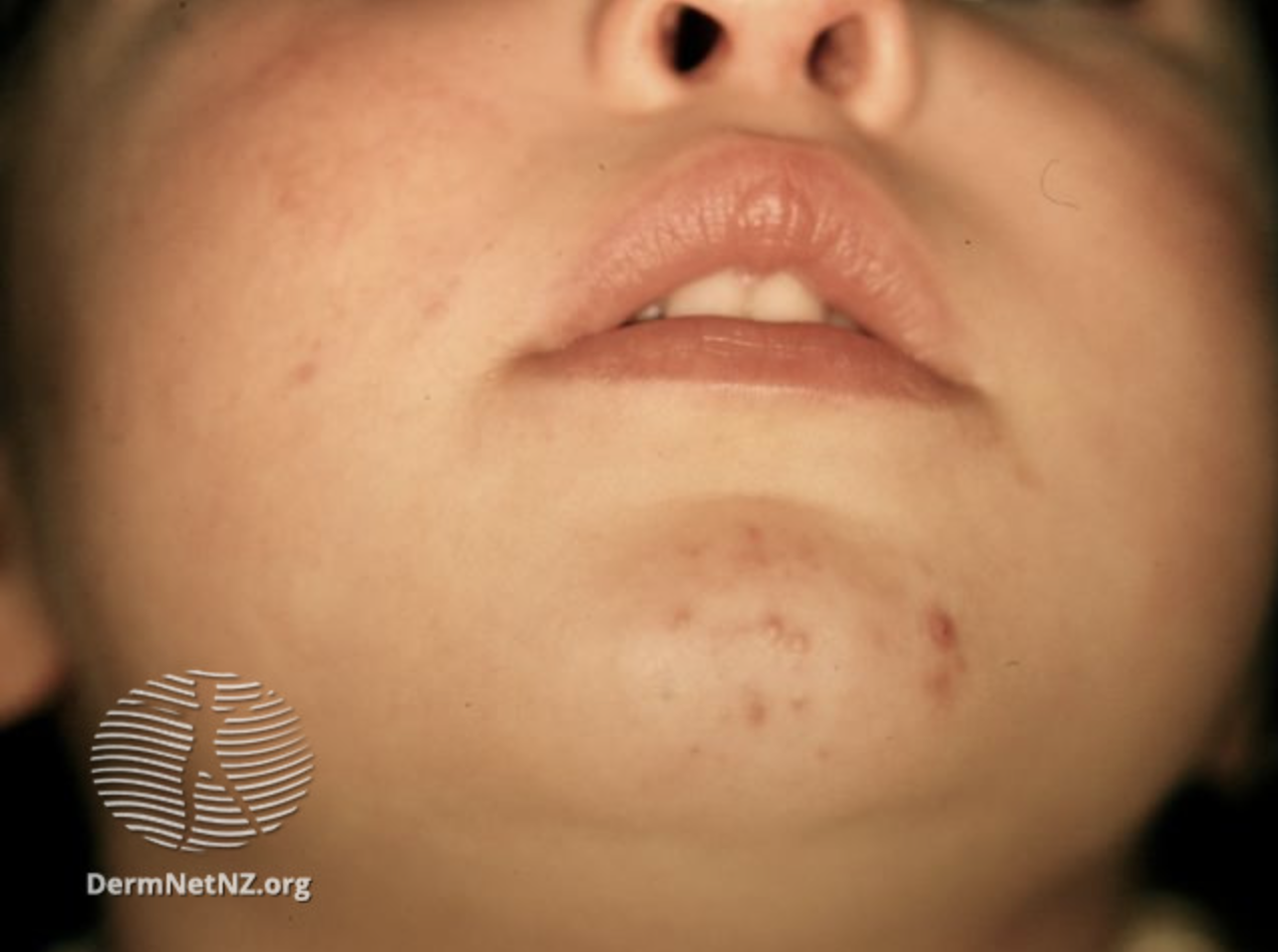 Rashes in newborns making sense of the dots and spots — MaternityMatters