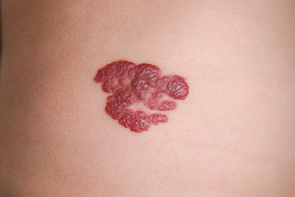 Birthmarks