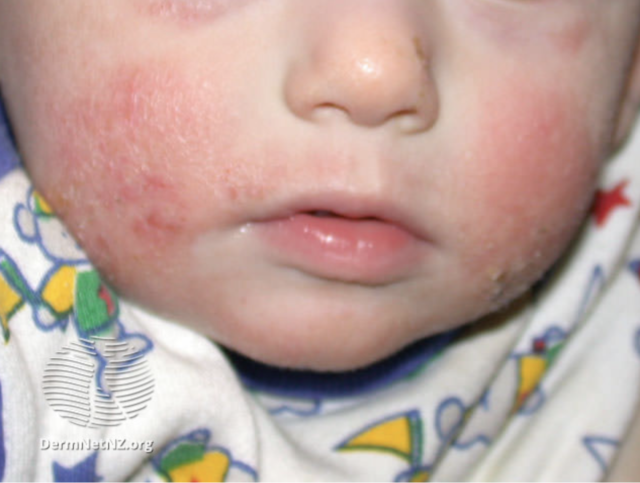 Eczema 