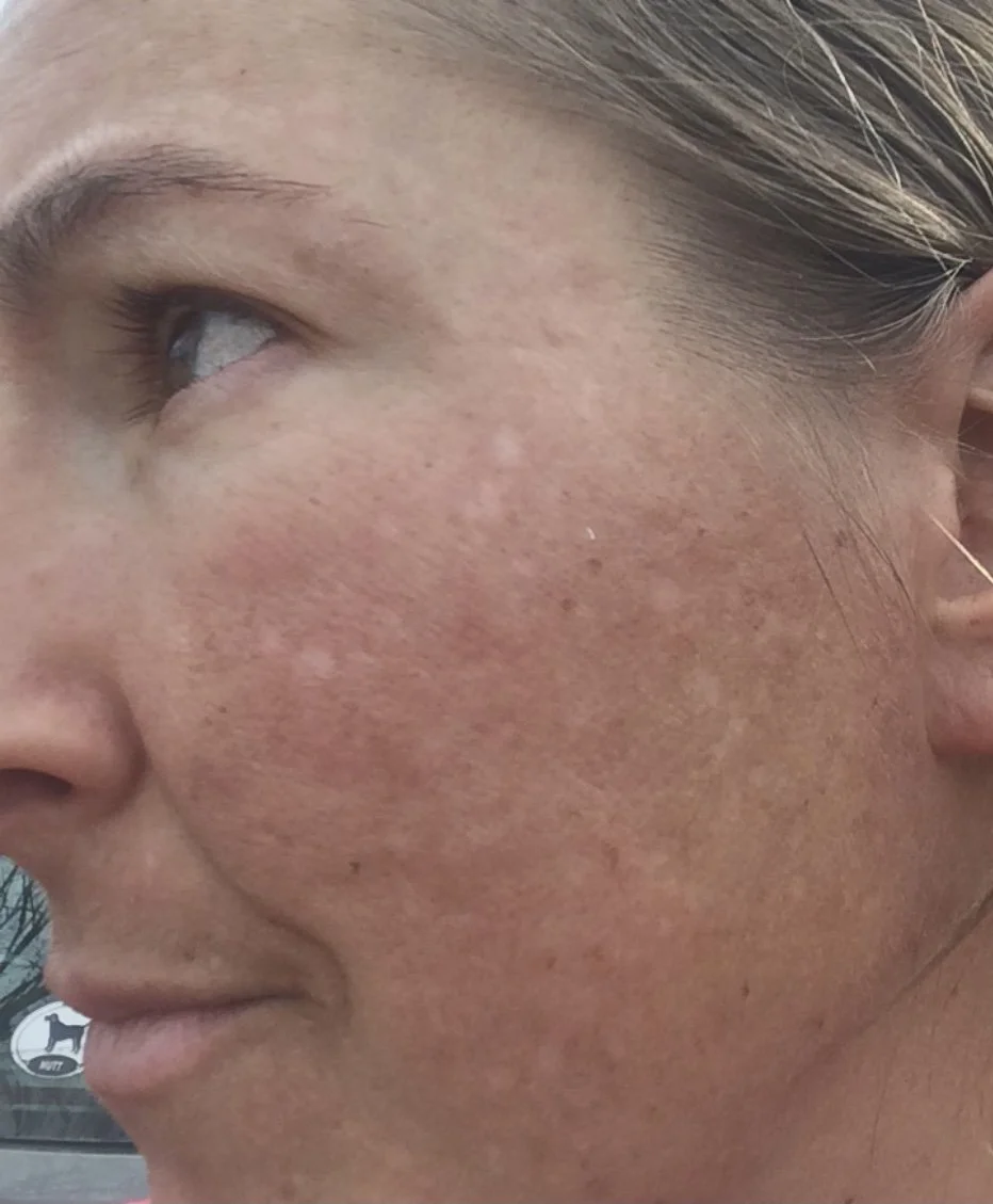 How To Treat Melasma From the Inside and Why Topical Treatments Don't Work