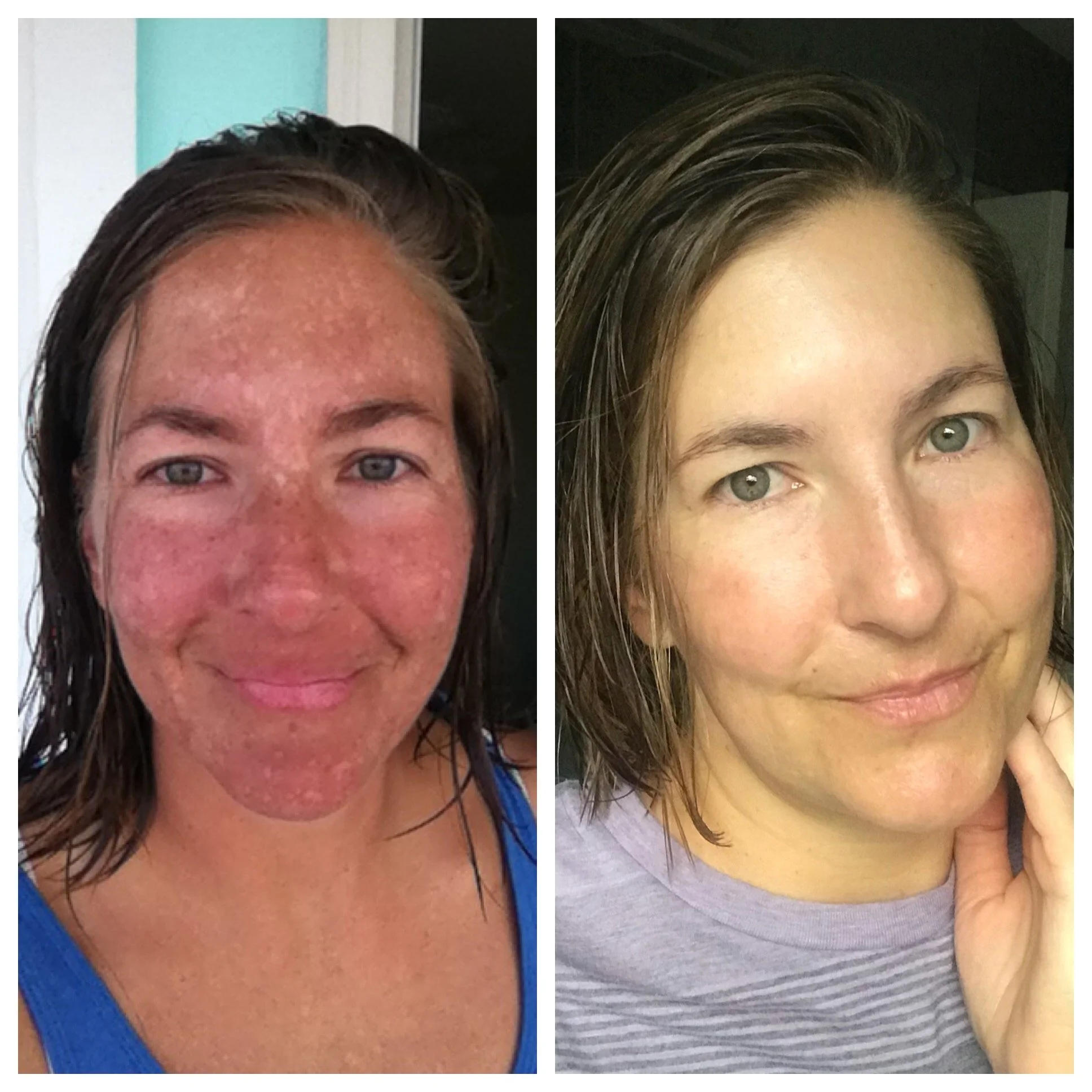 The Best Skincare Creams for Melasma + Hyperpigmentation