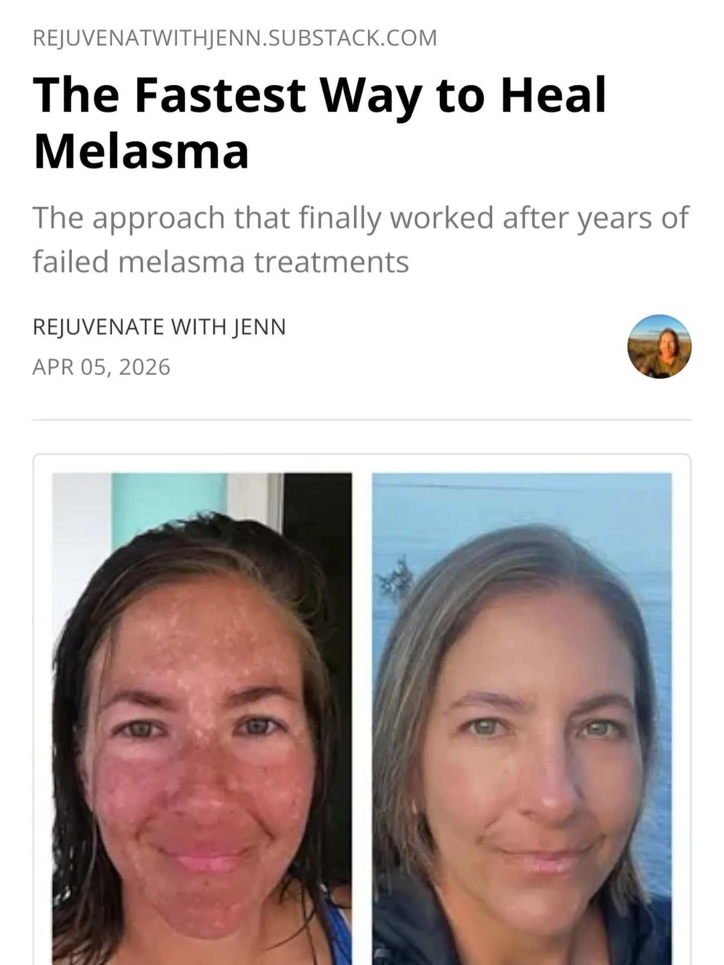 One of the most frustrating things about melasma is that it takes time to reverse. And that&rsquo;s exactly why so many women are enticed by treatments that promise fast results: lasers, peels, bleaching creams, some even promising overnight results.