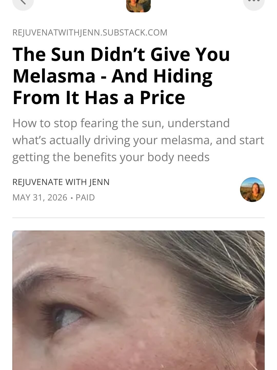 Something I get asked all the time: if the sun triggers melasma, how have you spent time in the sun for years without it coming back?

It&rsquo;s a fair question. Because everything we&rsquo;ve been told about melasma says the sun is the enemy. Avoid