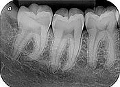 periapical2.jpg