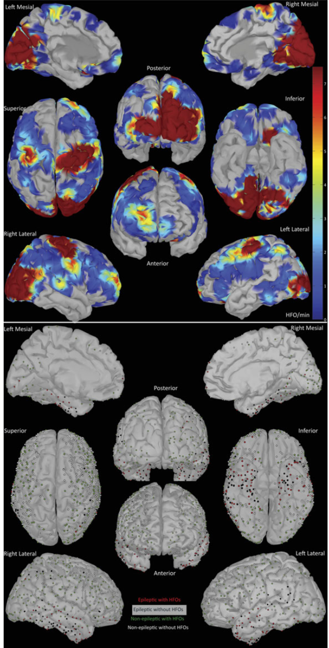 (A) Distribution of nonepileptic HFOs weighted by rate (HFO event/min, primarily ripples). The rate is projected on a triangular mesh model of a standardized brain. The heat map represents the average rate of HFO events (HFO event/min). We used nearest neighbor linear interpolation in 100 vertices around the center of each electrode contact. Power maps of detected HFOs (not shown) mirror the maps of HFO rates. Areas that were not sampled appear uncolored. (B) Summary of electrode contact placement, classification, and association with HFOs in all the patients. Contact locations are spatially transformed and coregis- tered with a standardized brain (MNI). The dots mark the location of the centers of the electrodes, and do not represent the size of the electrode. red dot, A contact with HFOs in an epileptic site; black, a contact without HFOs in an epileptic site; Green dot, a contact with HFOs in a nonepileptic site; white dot, a contact without HFOs in a nonepileptic site.