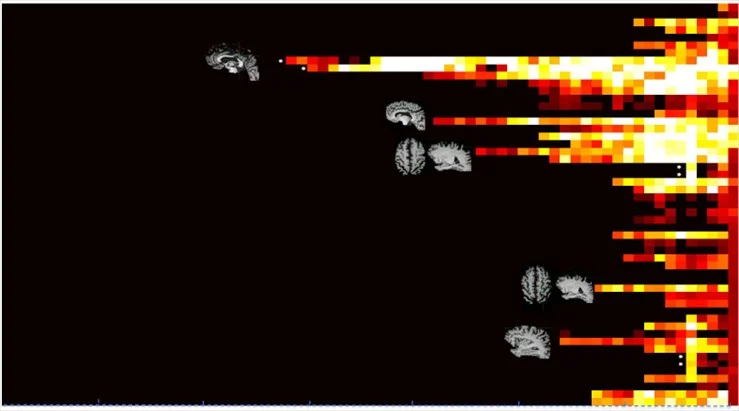 Sequential spread of seizure (beta-band) in a seemingly less-localizable onset by standard visual analysis