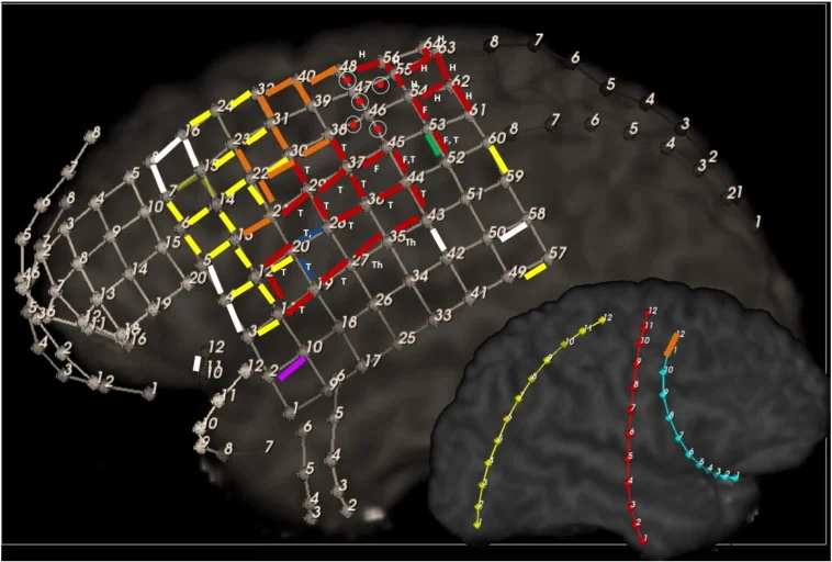 Functional map from cortical stimulation. Red: positive motor; Green: sensory; Yellow: Language. Orange: Stimulations that triggered consistent impairment of consciousness with trains greater than 2 seconds; Circle with central red dot: Frontal eye field ; Blue: negative tongue motor; Purple: Non-epileptic experiential auditory déjà vu; White: Tested up to 12 mA with no observable function identified. T = tongue, Th = throat, F = face, H = hand.