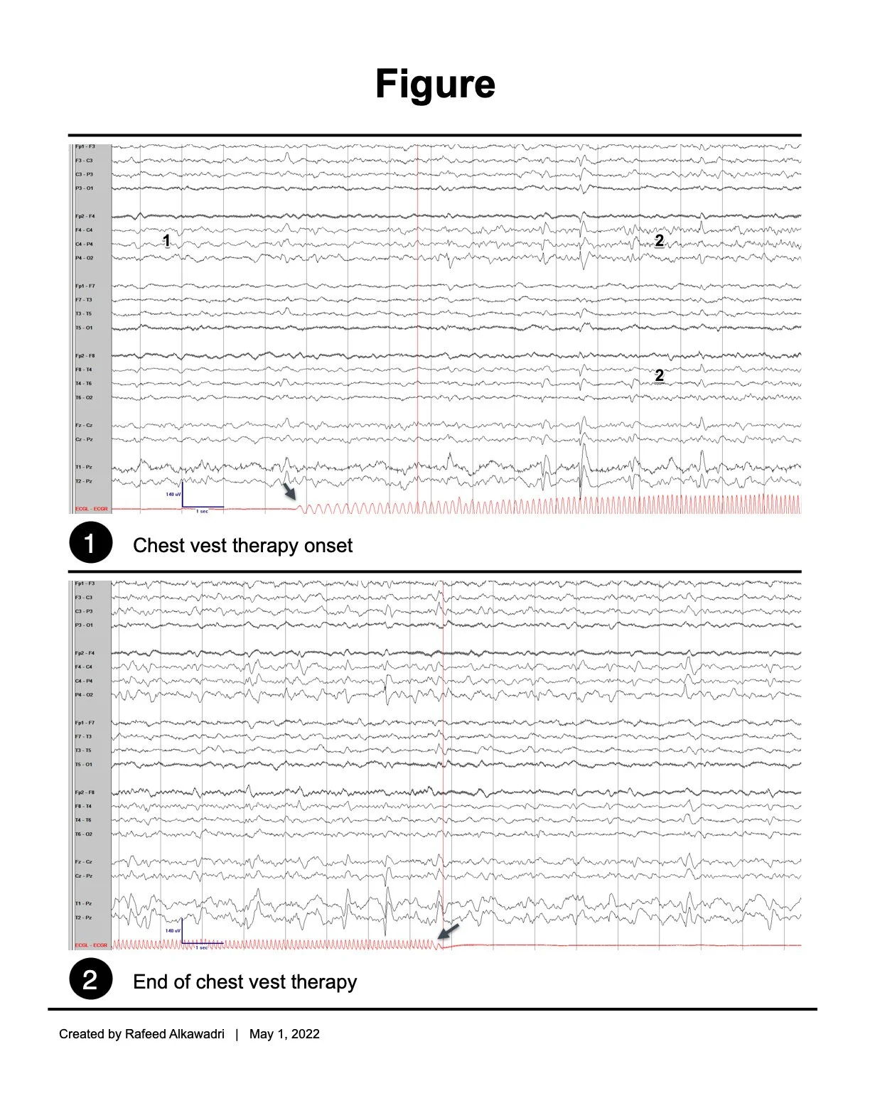 Two stacked EEG traces show a rhythmic pattern appearing during chest-vest therapy and stopping abruptly when the therapy ends.