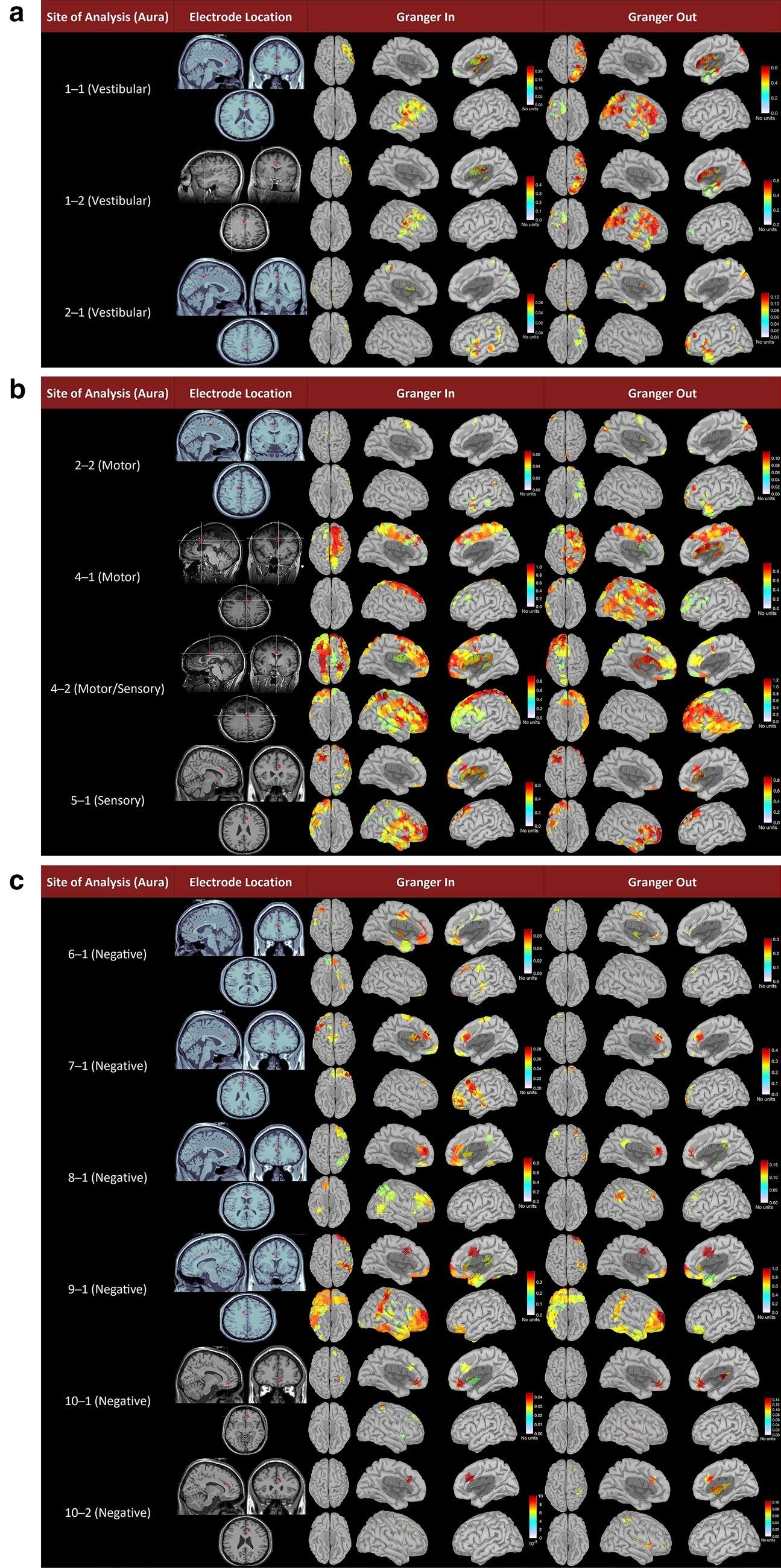 Multimodal brain figure showing intracranial electrode sites and Granger-in and Granger-out connectivity maps across vestibular, motor, sensory, and negative-response stimulation sites.