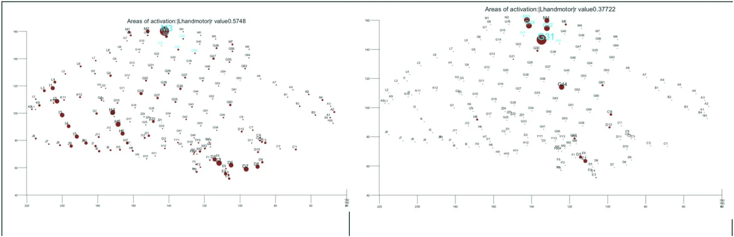 Two electrode-space maps compare broad hand-motor activation from a conventional method with a more selective custom analysis; cyan labels mark electrical-stimulation reference contacts.
