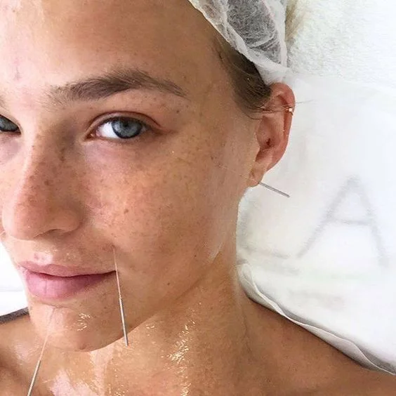 July Promotion-Cosmetic Acupuncture