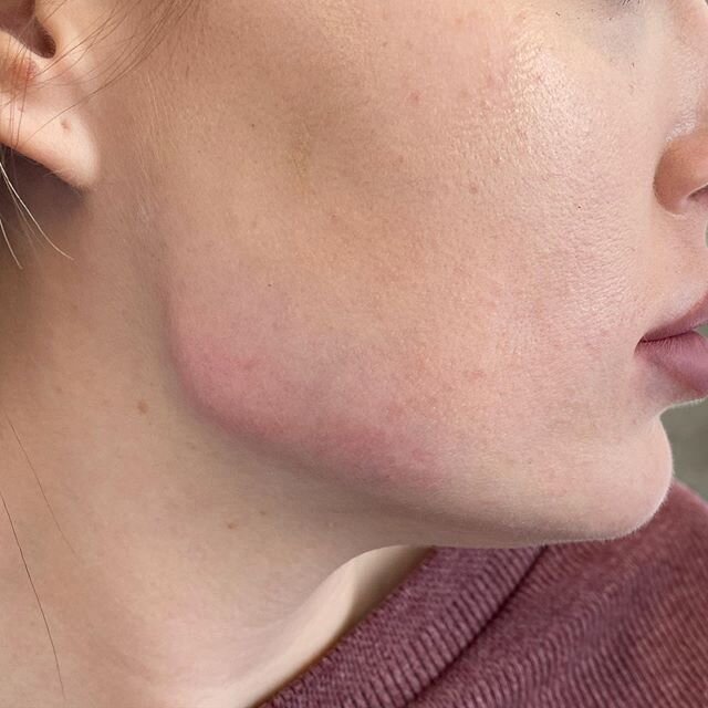Gorgeous jawline with Revanesse Shape by cannula.