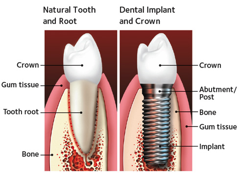 Implants — Hanover Dental