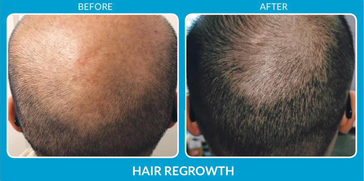Jimmy hair growth.png