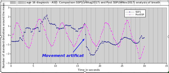 Respiratory pattern, before SSP, 3 months later. Samar Singh, PhD
