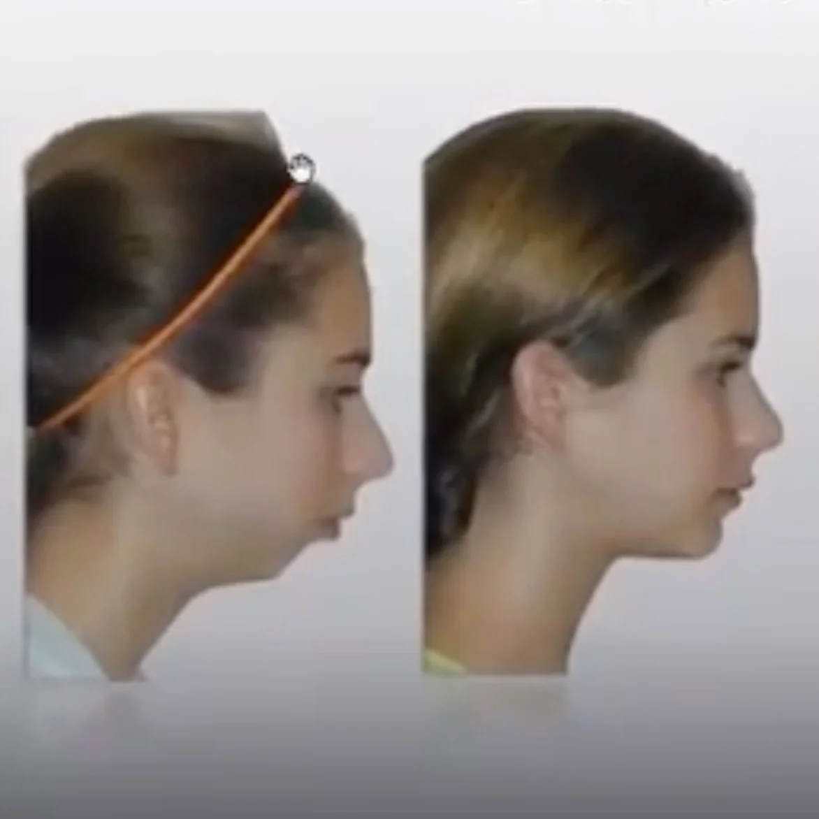 Understanding Proper Craniofacial Growth