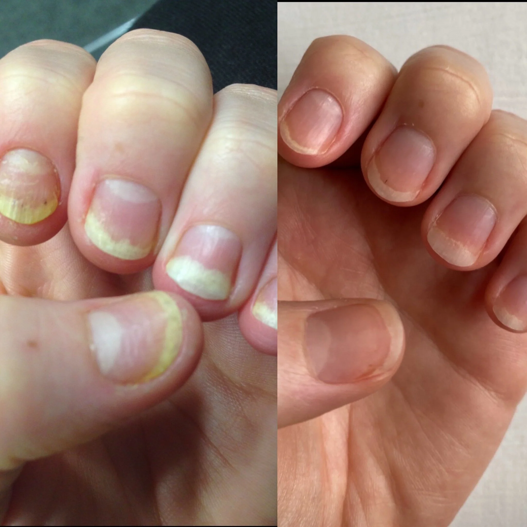 Healing Nail Psoriasis Naturally
