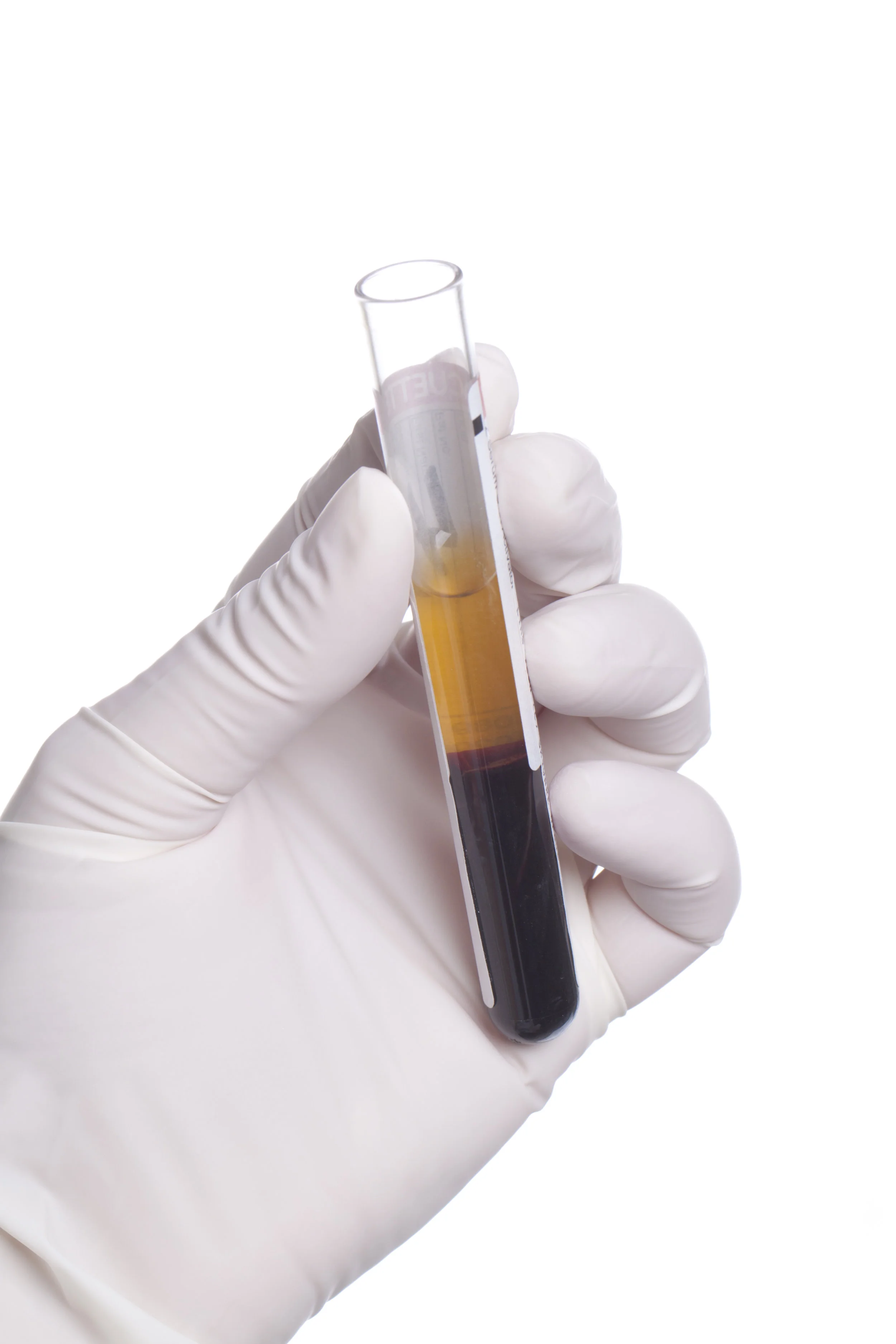 Spa Scare: HIV and Other Transmissible infections