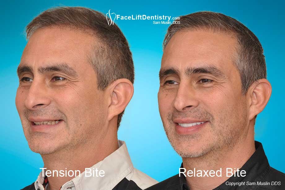 Face Lift Dentistry