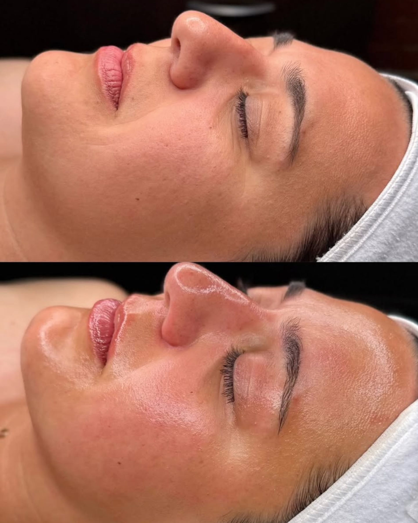 Hydrafacial.png