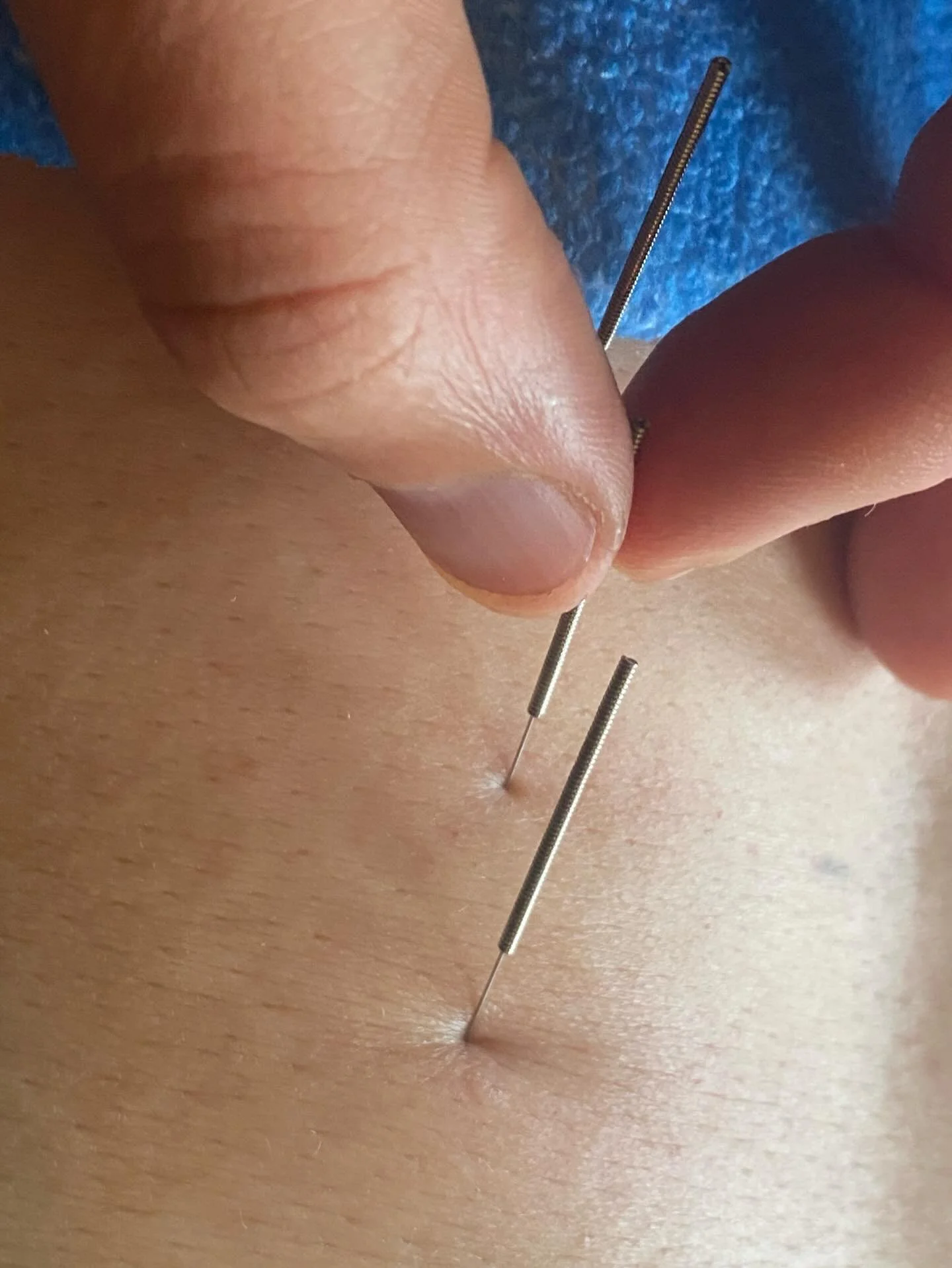 Dry-Needling&hellip; het is g&eacute;&eacute;n quick-fix, m&aacute;&aacute;r kan een waardevolle tool zijn.

Zoals mijn cli&euml;nten kunnen bevestigen, needle ik zeker niet iedere sessie r&egrave;n zeker niet wanneer je naalden angst hebt of het nie
