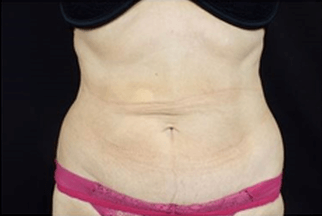 12 Weeks after first treatment