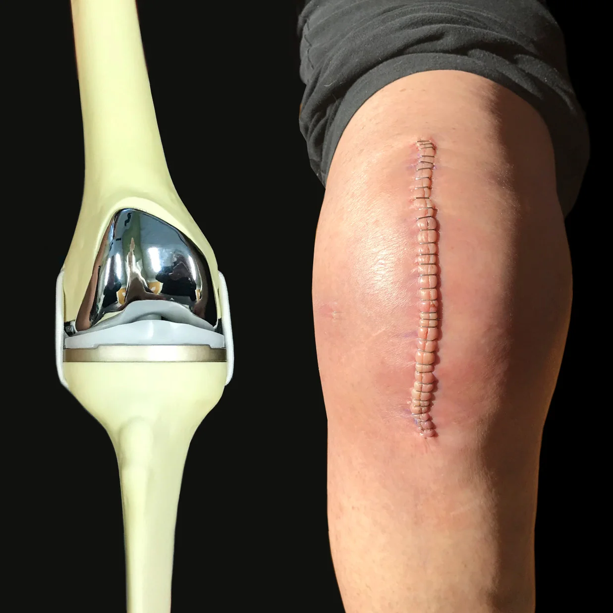 Total Knee Replacement A Survivor's Guide TKR A Survivor's Guide