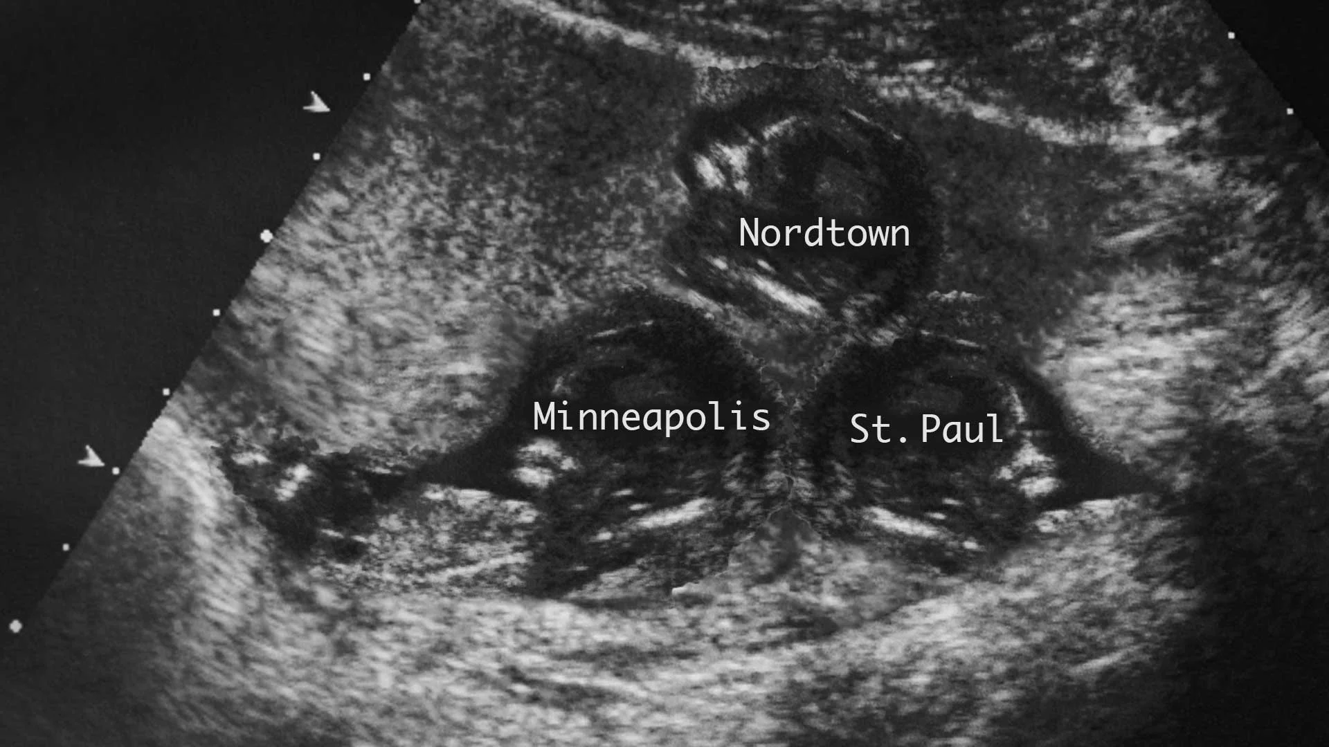 Scientists-discover-Minneapolis-and-St.-Paul-killed-triplet-city-in-the-womb.jpg