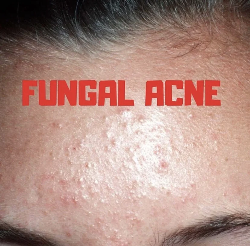 Learning Together : Wie man Fungal Akne erkennen, behandeln und vorbeugen kann.