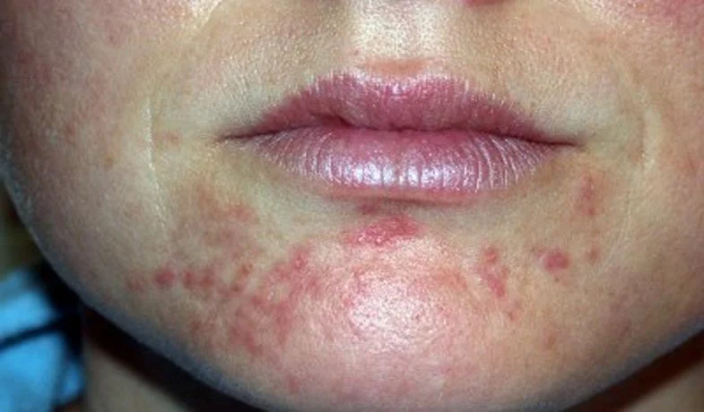 Learning Together: Periorale Dermatitis - Mögliche Ursachen und Behandlungsformen