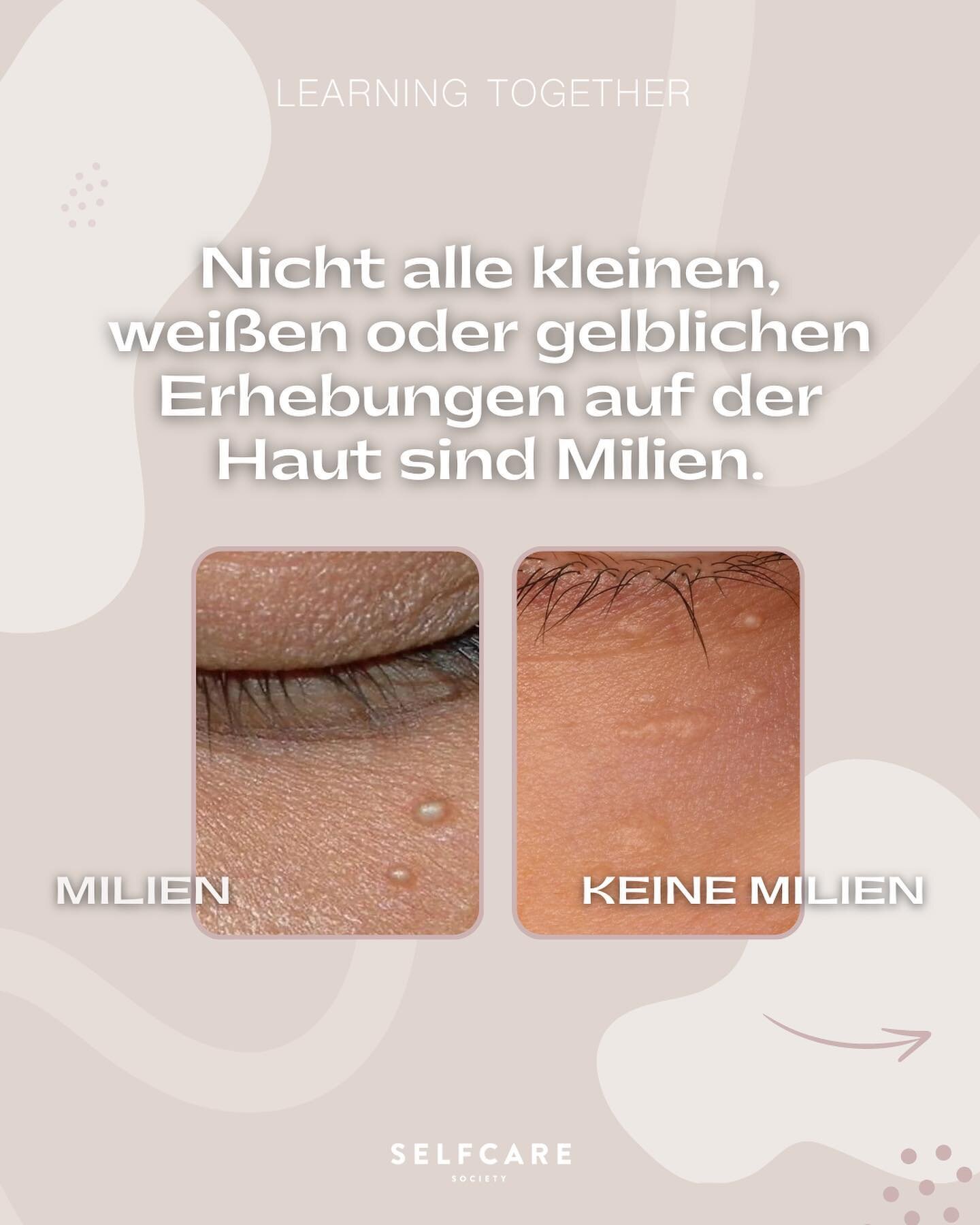 Learning Together: Milien &amp; Syringome im Vergleich ✨

Nicht jede kleine, wei&szlig;liche oder gelbliche Erhabenheit auf unserer Haut ist zwangsl&auml;ufig eine Milie. 📌

Auf unserer Haut k&ouml;nnen zahlreiche Zust&auml;nde und Ver&auml;nderunge