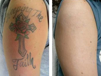 Tattoo removal 3.jpg