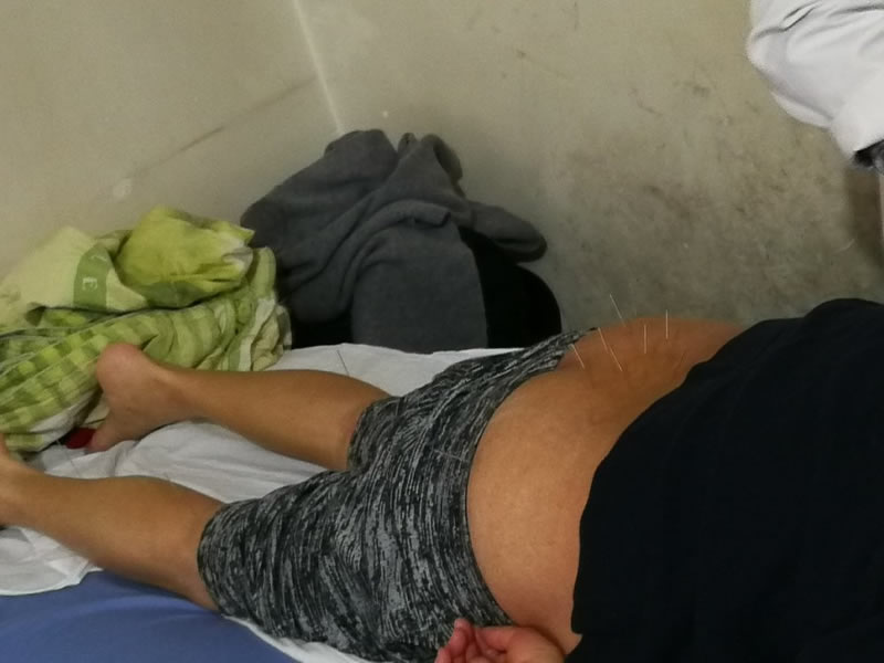 Very ordinary looking acupuncture for back pain.