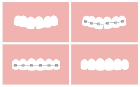 fast brace diagram.png