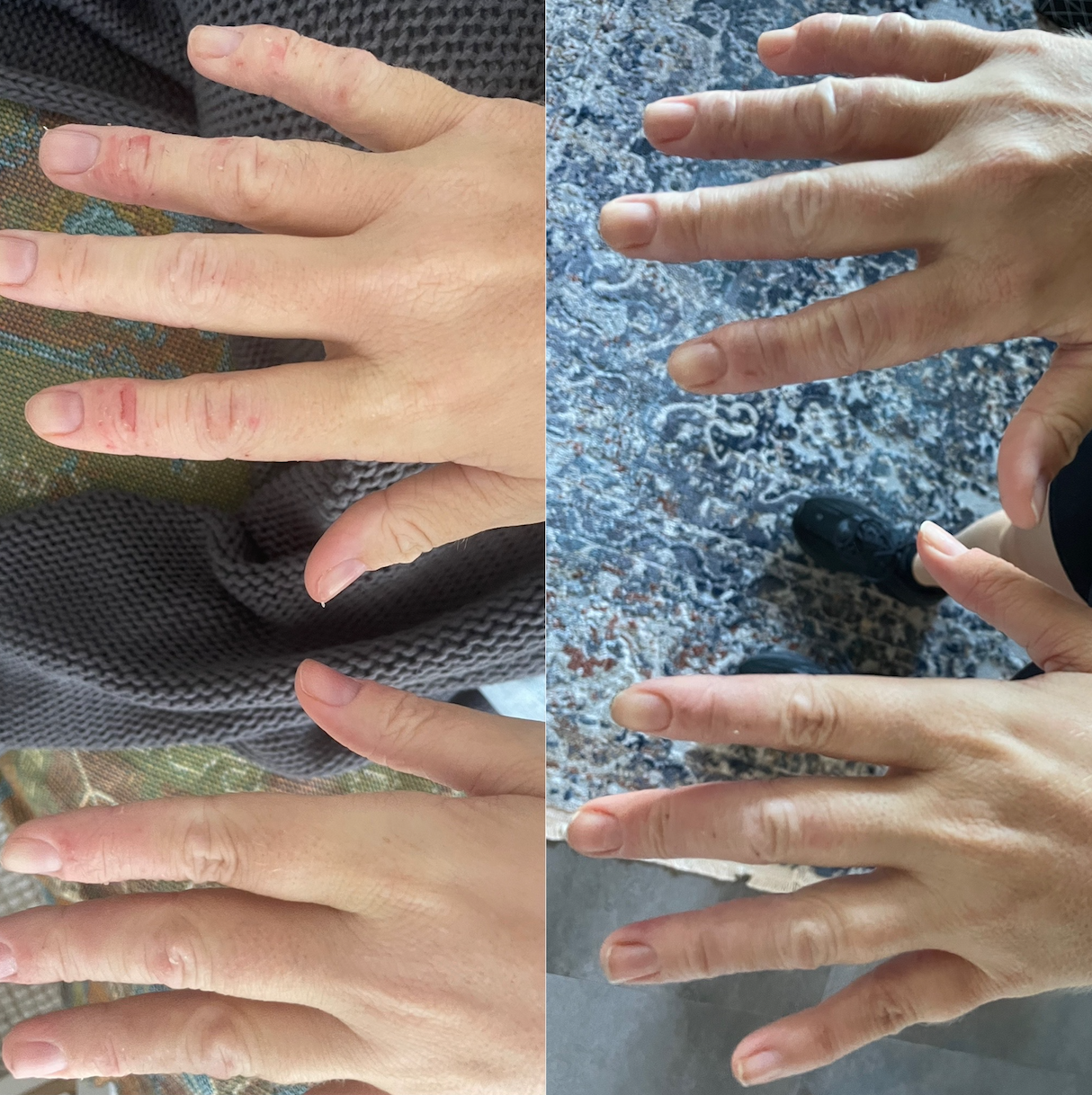 Healing Eczema Beyond the Skin: How Kinesiology Addresses the Root Cause