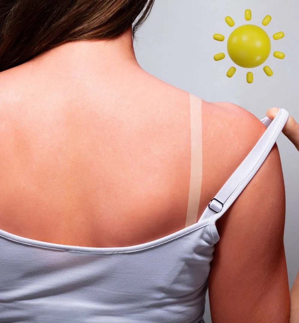Sunburn Treatments